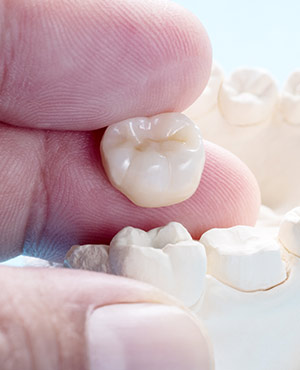 Dental Crowns Near Me in Bay Area, San Jose, CA 