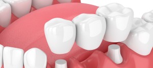 Affordable Dental Bridges Near Me Serving Bay Area San Jose, CA Affordable Dental Bridges Near Me Serving Bay Area San Jose, CA