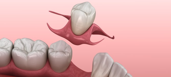Cost of New Dental Crowns Near Me in San Jose, CA Cost of New Dental Crowns Near Me in San Jose, CA