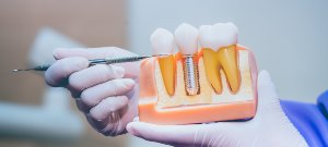 Dental Implant Crowns Serving Bay Area, San Jose, CA
