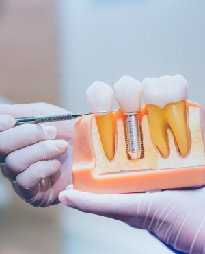 Dental Implant Crowns Serving Bay Area, San Jose, CA