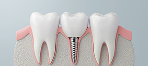 Where Can I Get Affordable Dental Implants Near Me in San Jose, CA Where Can I Get Affordable Dental Implants Near Me in San Jose, CA