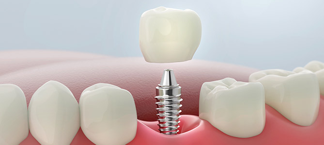 Single Tooth Implant Bay Area San Jose CA Single Tooth Implant Bay Area San Jose CA