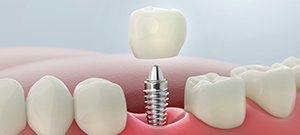 Single Tooth Implant Bay Area San Jose CA Single Tooth Implant Bay Area San Jose CA