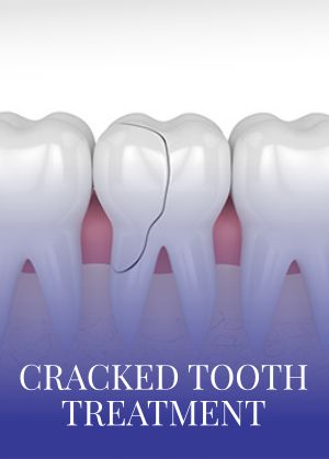 Cracked Tooth Treatment Serving in Bay Area, San Jose, CA