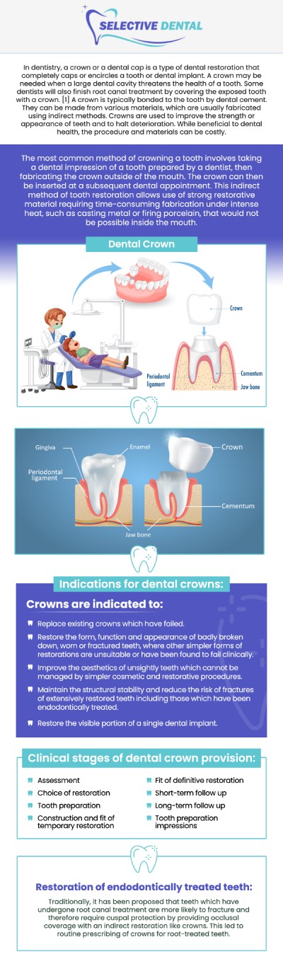 Dental crowns are custom-made to fit over a damaged tooth, providing strength and restoring its appearance. They are often used to repair teeth that are severely decayed, cracked, or worn down. Crowns can be made from various materials, including porcelain, metal, or a combination of both, ensuring durability and a natural look. Whether you're looking to restore a single tooth or improve the function and appearance of your smile, dental crowns offer an effective solution. Talk to Dr. Victoria Vuong, DDS, today about our dental crown procedures and how they can benefit your oral health. For more information, contact us or schedule an appointment online. We are conveniently located at 3151 South White Road, Suite 203 San Jose, CA 95148. Dental crowns are custom-made to fit over a damaged tooth, providing strength and restoring its appearance. They are often used to repair teeth that are severely decayed, cracked, or worn down. Crowns can be made from various materials, including porcelain, metal, or a combination of both, ensuring durability and a natural look. Whether you're looking to restore a single tooth or improve the function and appearance of your smile, dental crowns offer an effective solution. Talk to Dr. Victoria Vuong, DDS, today about our dental crown procedures and how they can benefit your oral health. For more information, contact us or schedule an appointment online. We are conveniently located at 3151 South White Road, Suite 203 San Jose, CA 95148.