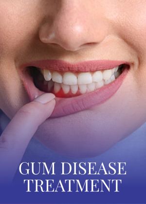 Gum Disease Treatment Serving in Bay Area, San Jose, CA