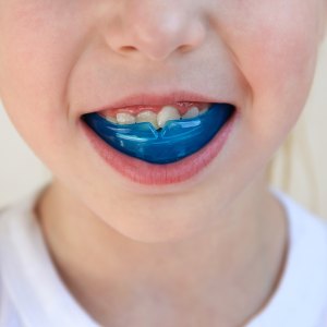 Custom Sports Mouth Guards in San Jose, CA